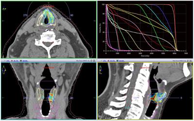 Is Single Cord Irradiation Going to Be a New Standard for T1a Glottic Carcinoma?